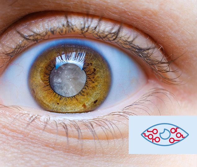 Glaucoma Doctor The Woodlands