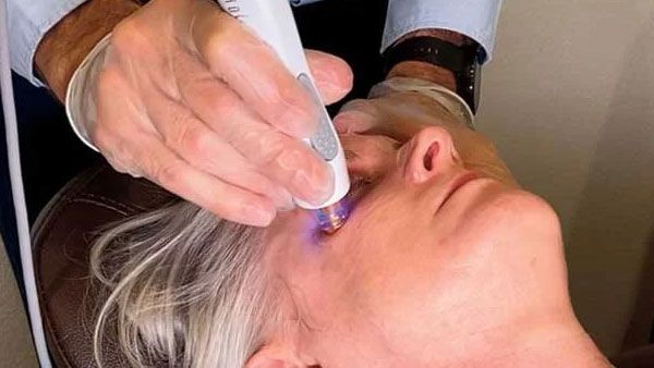 Lumenis OptiLight IPL Therapy