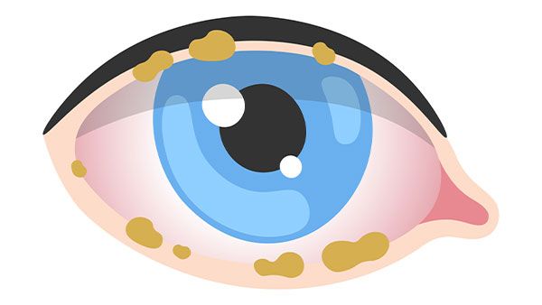 Blepharitis Treatment