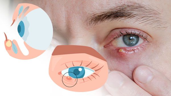 Meibomian Gland